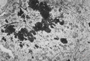 M,4y. | mitosis - retroperitoneal neuroblastoma M,4y. | mitosis - retroperitoneal neuroblastoma